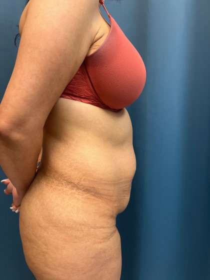 Tummy Tuck Before & After Patient #417