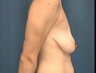 Breast Lift Before & After Patient #1923