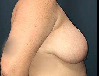 Breast Lift Before & After Patient #1934
