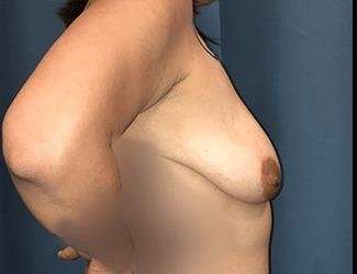 Breast Lift Before & After Patient #1954