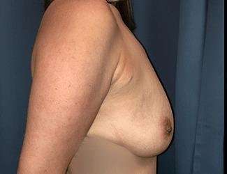 Breast Lift Before & After Patient #1965