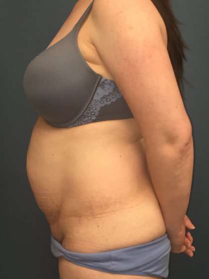Tummy Tuck Before & After Patient #428