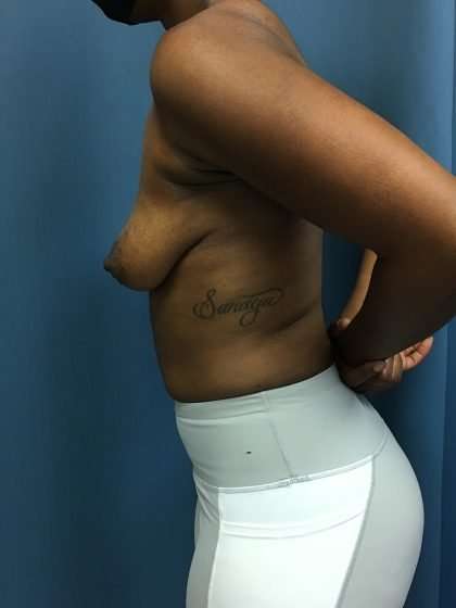 Breast Lift Before & After Patient #2016