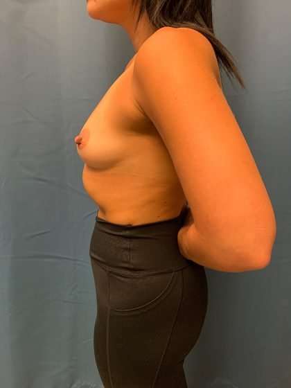 Breast Augmentation Before & After Patient #2049