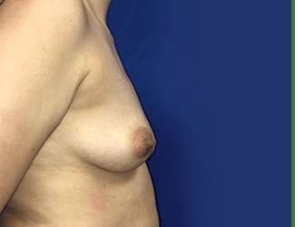 Breast Augmentation Before & After Patient #2069