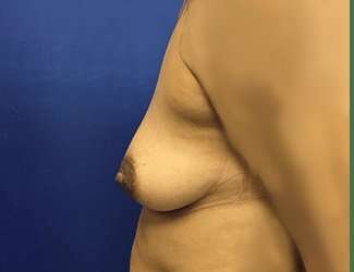 Breast Augmentation Before & After Patient #2080