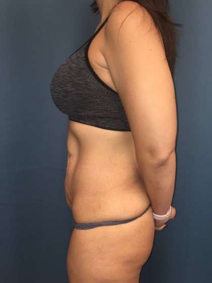 Tummy Tuck Before & After Patient #439