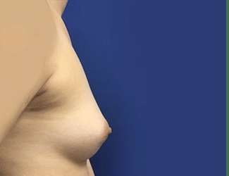 Breast Augmentation Before & After Patient #2102