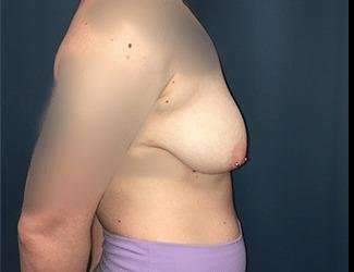Breast Augmentation Before & After Patient #2111