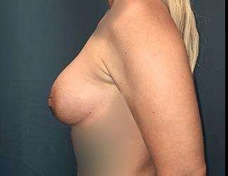 Breast Augmentation Before & After Patient #2122