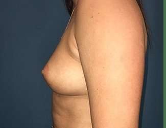 Breast Augmentation Before & After Patient #2144