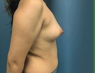 Breast Augmentation Before & After Patient #2153