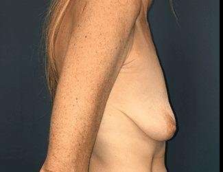 Breast Augmentation Before & After Patient #2162
