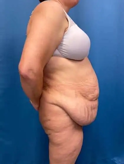 Tummy Tuck Before & After Patient #446
