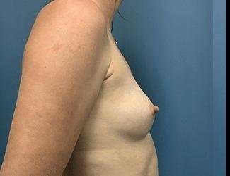 Breast Augmentation Before & After Patient #2191