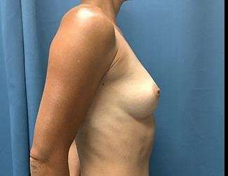 Breast Augmentation Before & After Patient #2202