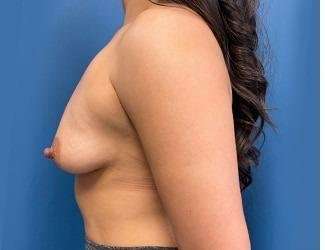 Breast Augmentation Before & After Patient #2213