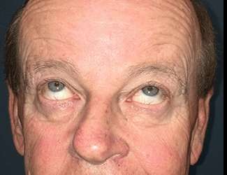 Blepharoplasty Before & After Patient #2251