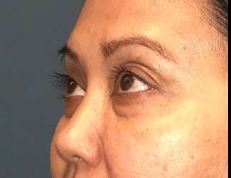 Blepharoplasty Before & After Patient #2260