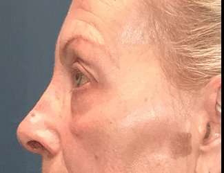 Blepharoplasty Before & After Patient #2271