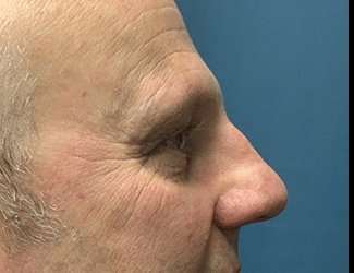 Blepharoplasty Before & After Patient #2282