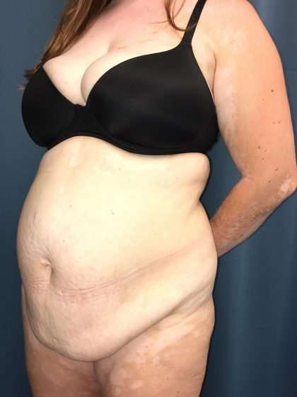 Tummy Tuck Before & After Patient #271