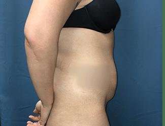 Tummy Tuck Before & After Patient #457