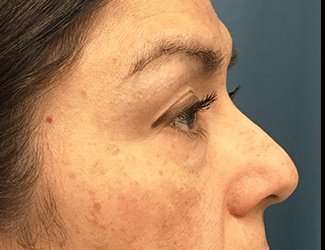 Blepharoplasty Before & After Patient #2293
