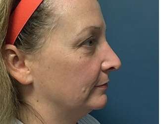 Blepharoplasty Before & After Patient #2308
