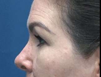Blepharoplasty Before & After Patient #2315