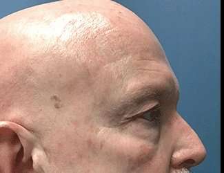 Blepharoplasty Before & After Patient #2328