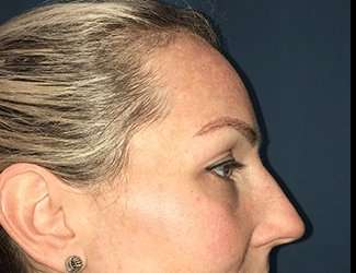 Blepharoplasty Before & After Patient #2339
