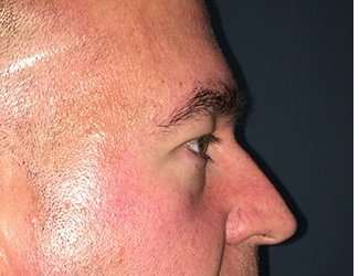 Blepharoplasty Before & After Patient #2352