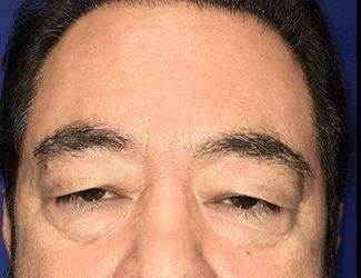 Blepharoplasty Before & After Patient #2355