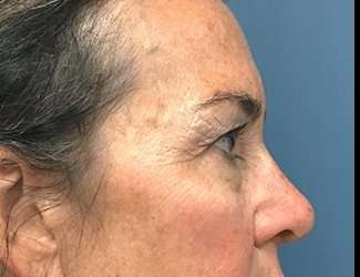 Blepharoplasty Before & After Patient #2368