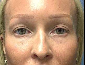 Blepharoplasty Before & After Patient #2371