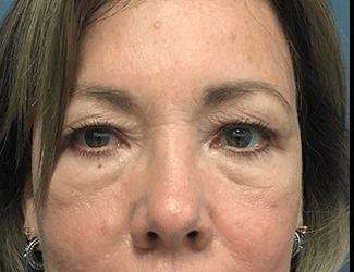 Blepharoplasty Before & After Patient #2374