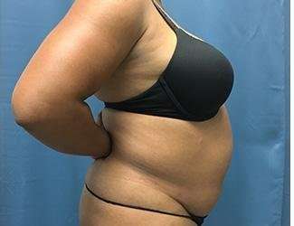 Tummy Tuck Before & After Patient #468