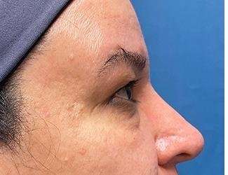 Blepharoplasty Before & After Patient #2385