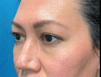 Blepharoplasty Before & After Patient #2390