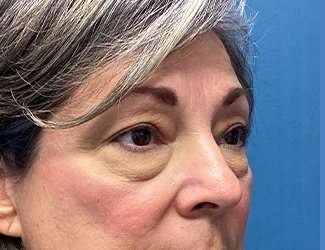 Blepharoplasty Before & After Patient #2397