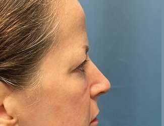 Blepharoplasty Before & After Patient #2408