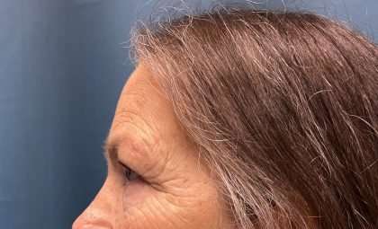 Blepharoplasty Before & After Patient #2419