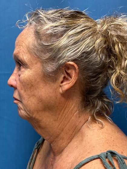 Blepharoplasty Before & After Patient #2430