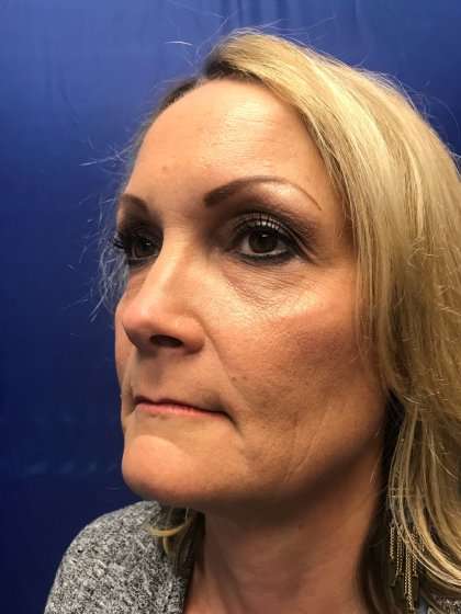 Blepharoplasty Before & After Patient #2437