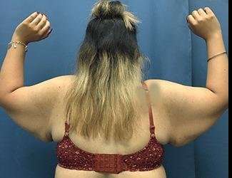 Arm Lift Before & After Patient #2464