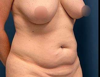 Tummy Tuck Before & After Patient #475
