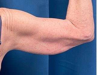 Arm Lift Before & After Patient #2473
