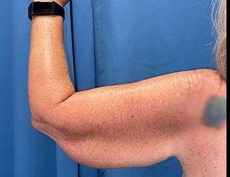 Arm Lift Before & After Patient #2482