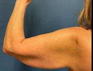 Arm Lift Before & After Patient #2491